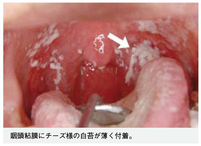 性 口内炎 カンジダ